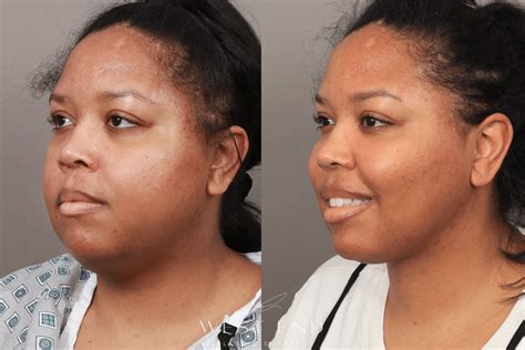 buccal fat removal 10 years later|Why You May Regret Buccal Fat Removal Later 